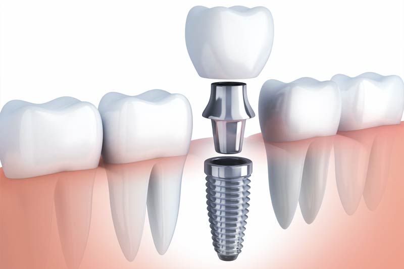 Implants in Austin