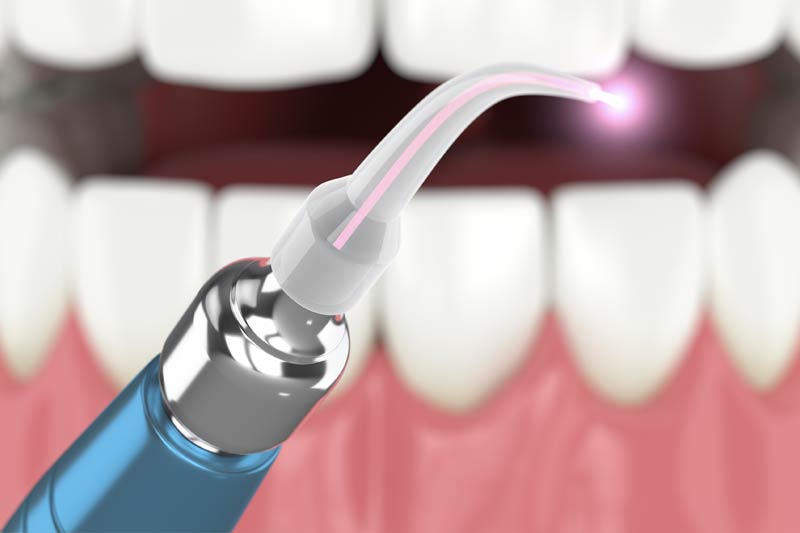 Laser Dentistry in Austin