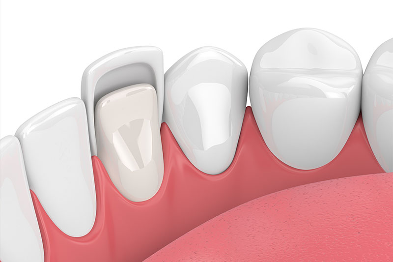 Veneers in Austin